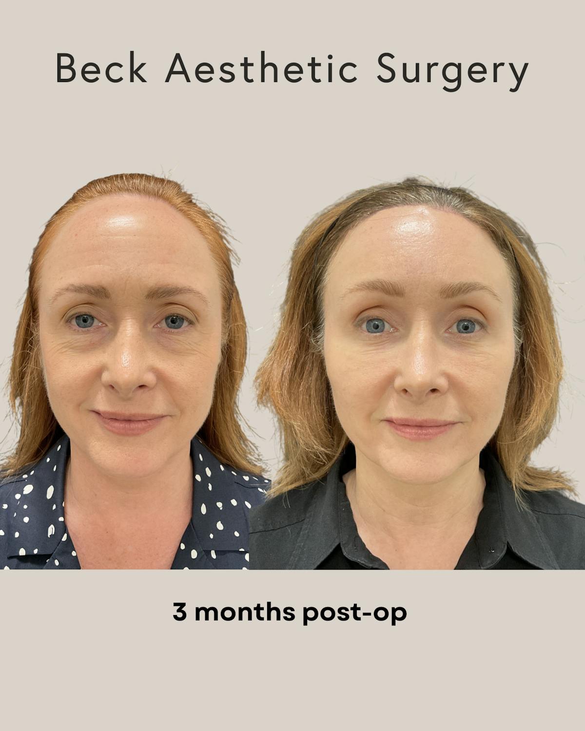 Facial Fat Grafting Before & After Gallery - Patient 195406 - Image 1