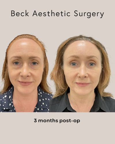 Facial Fat Grafting Before & After Gallery - Patient 195406 - Image 1