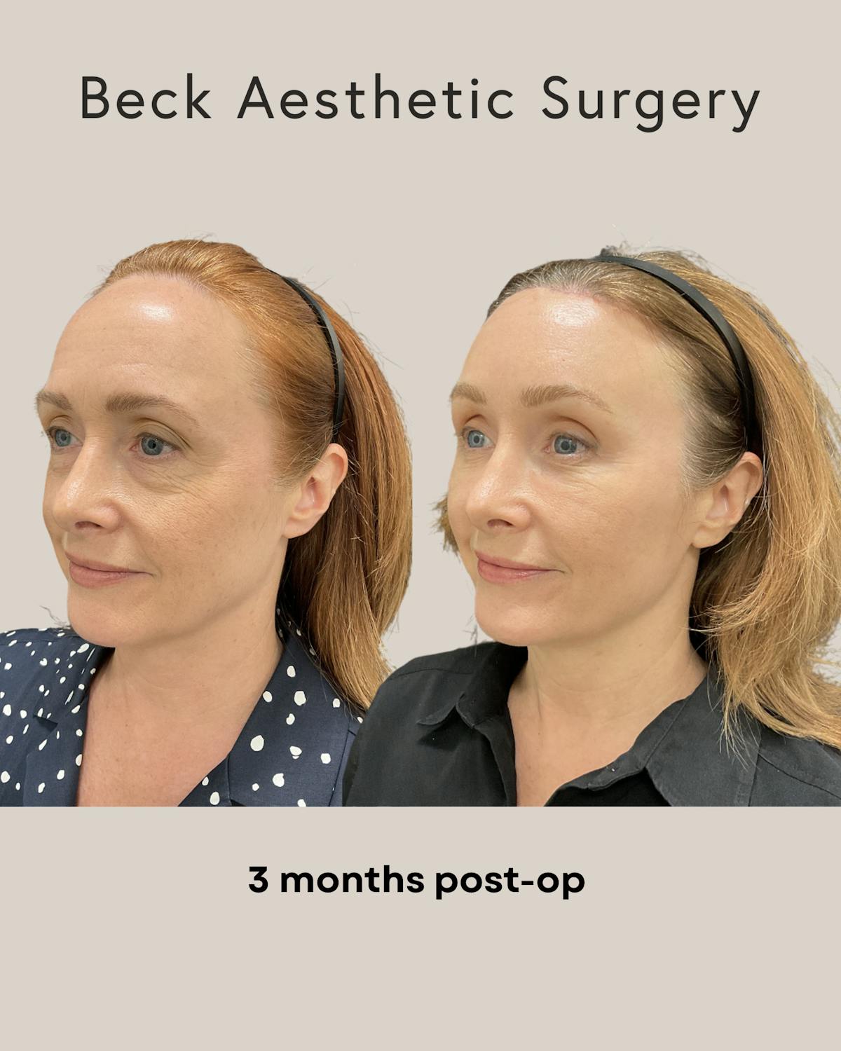 Facial Fat Grafting Before & After Gallery - Patient 195406 - Image 2