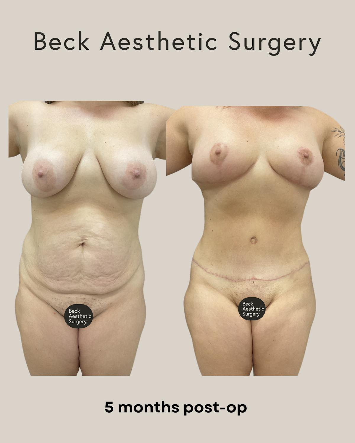 Mommy Makeover Before & After Gallery - Patient 240359 - Image 1