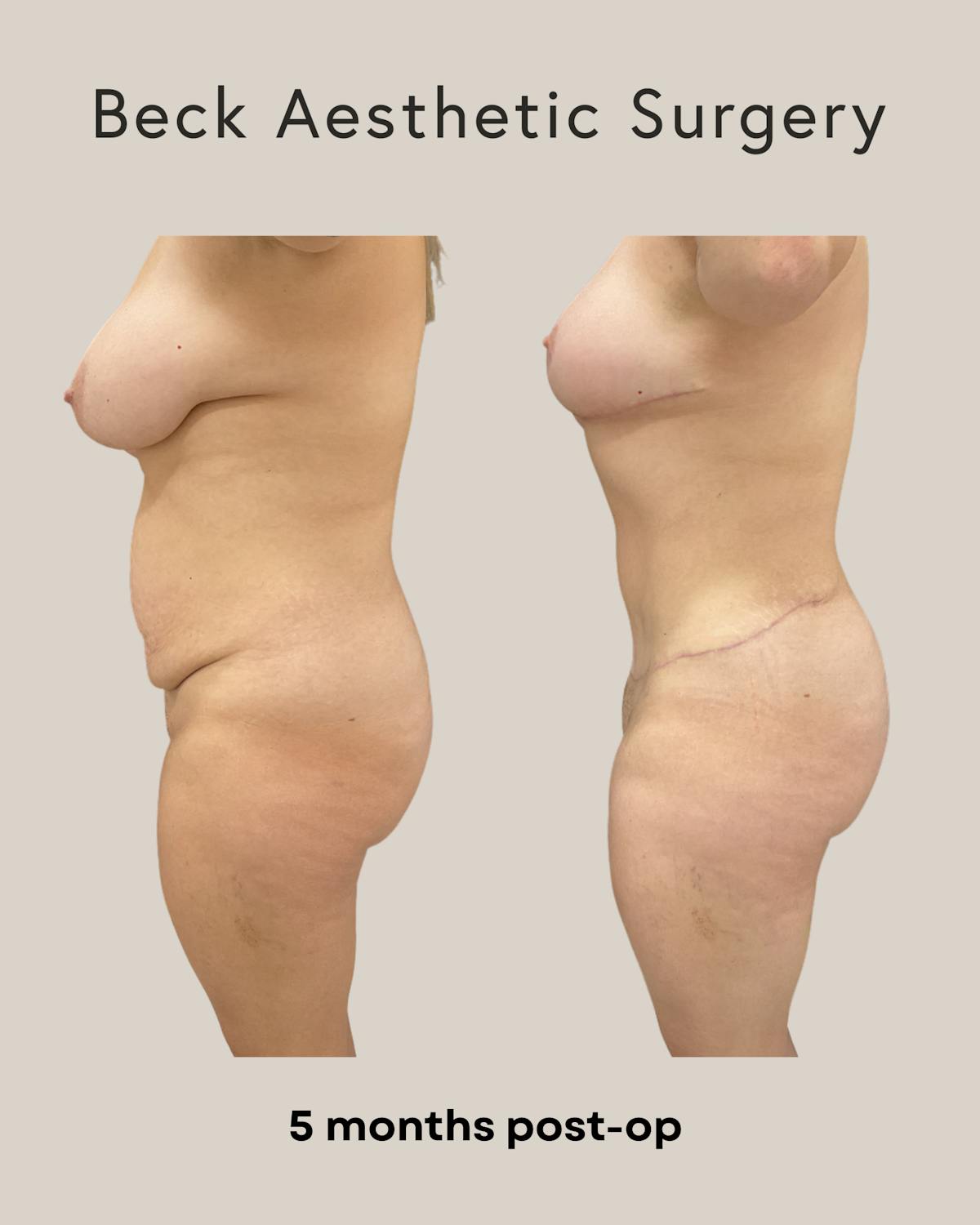 Mommy Makeover Before & After Gallery - Patient 240359 - Image 2
