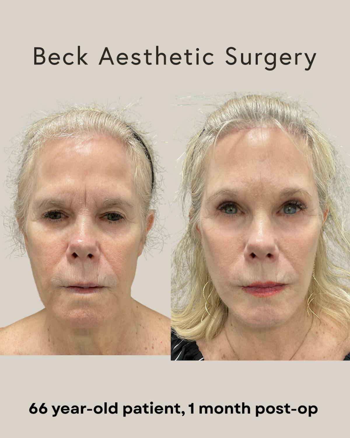 Facelift Before & After Gallery - Patient 109494 - Image 1