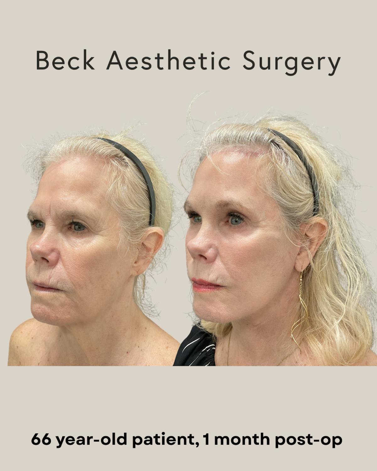 Facelift Before & After Gallery - Patient 109494 - Image 2