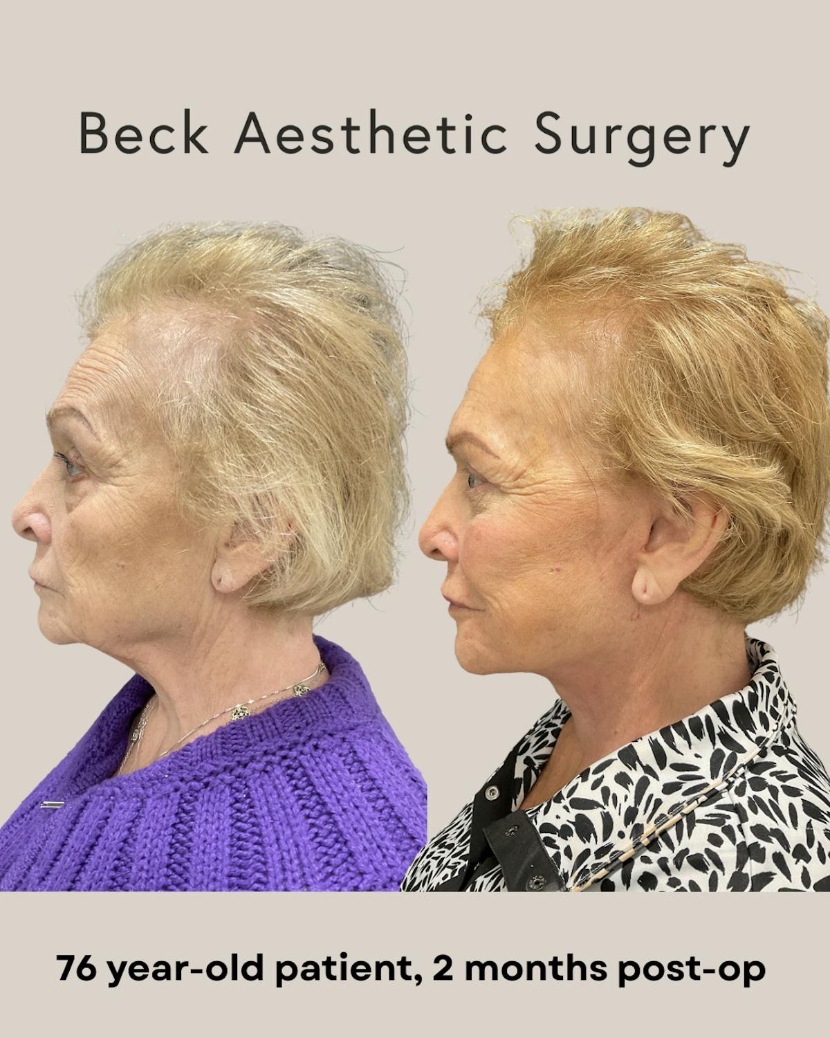 Facelift Before & After Gallery - Patient 136191 - Image 3