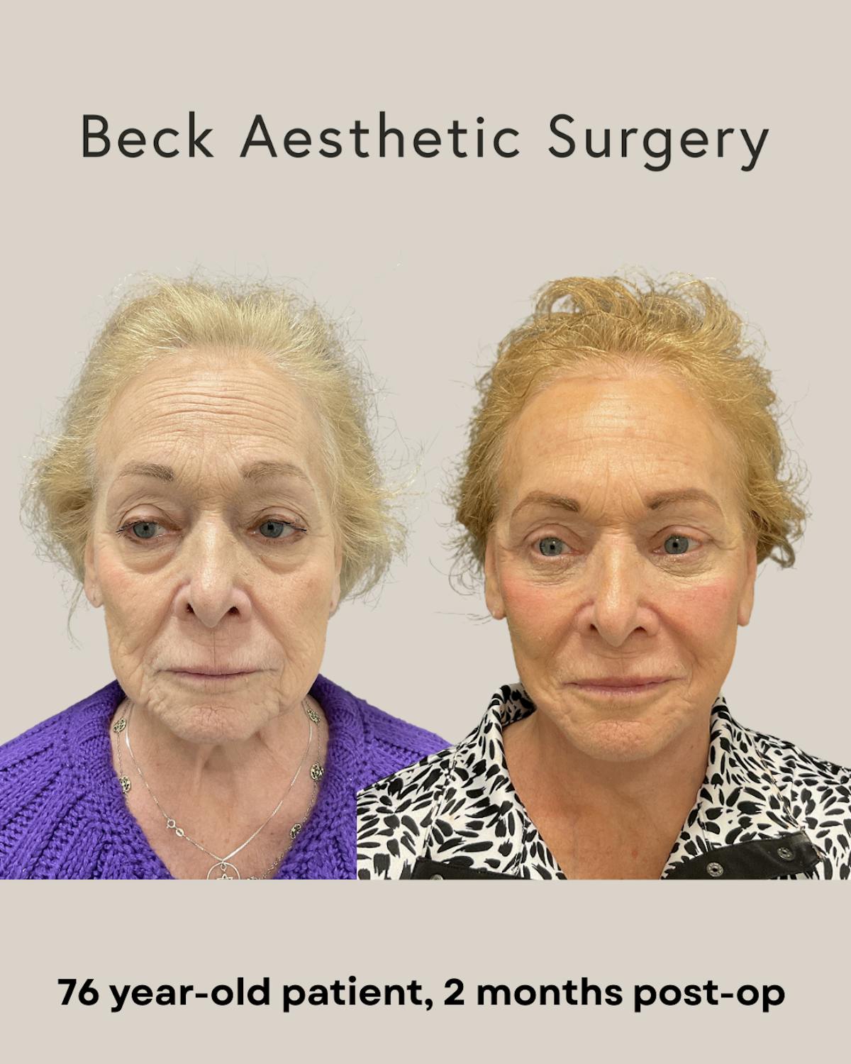 Facelift Before & After Gallery - Patient 136191 - Image 1