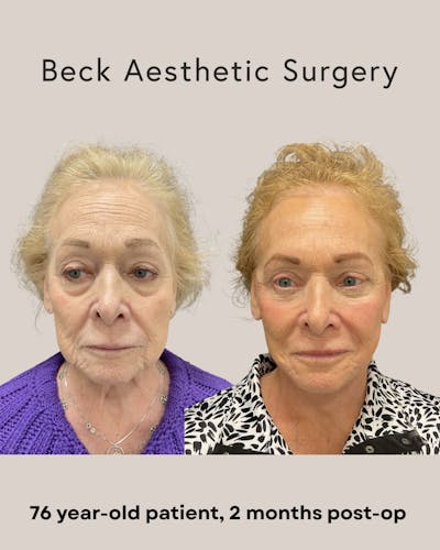 Facelift Before & After Gallery - Patient 136191 - Image 1