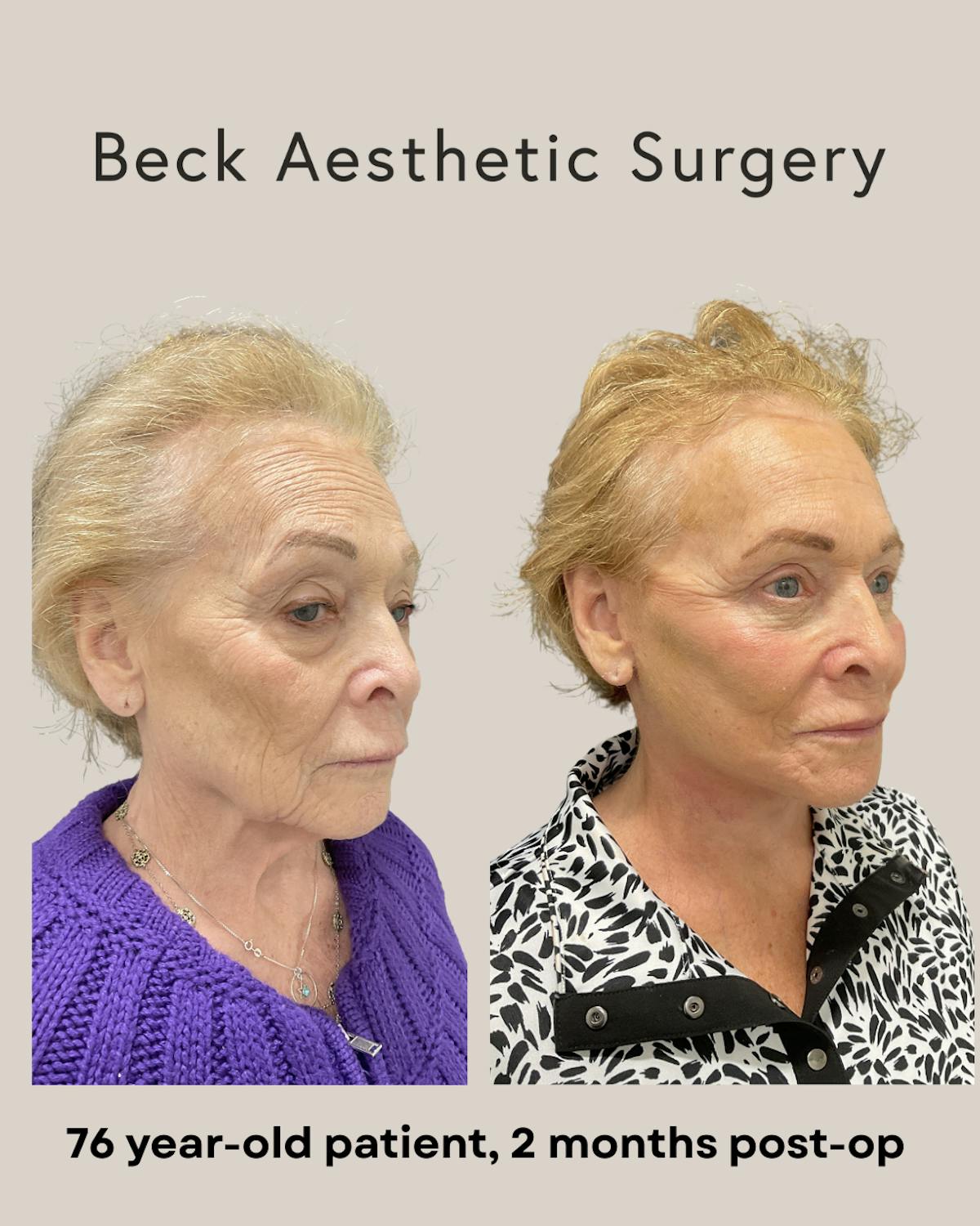 Facelift Before & After Gallery - Patient 136191 - Image 2