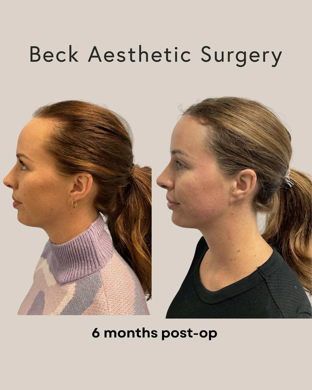 Forehead Reduction Before & After Gallery - Patient 220285 - Image 2