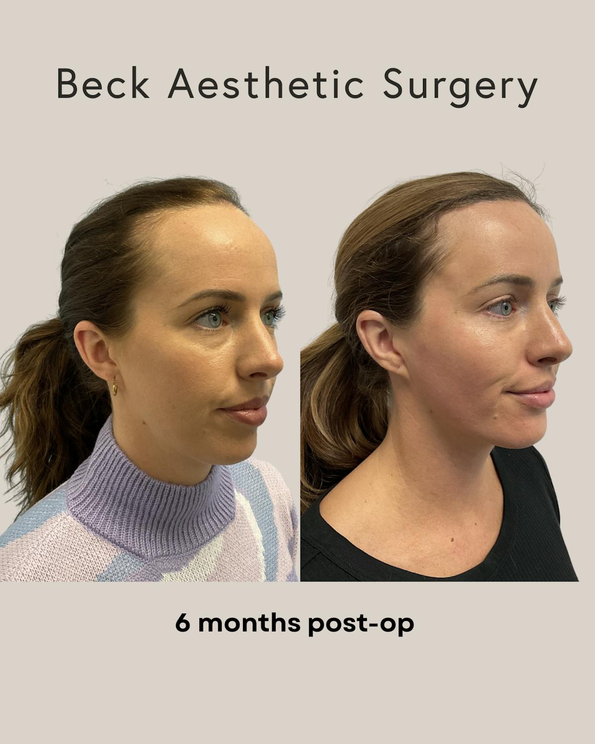 Forehead Reduction Before & After Gallery - Patient 220285 - Image 1