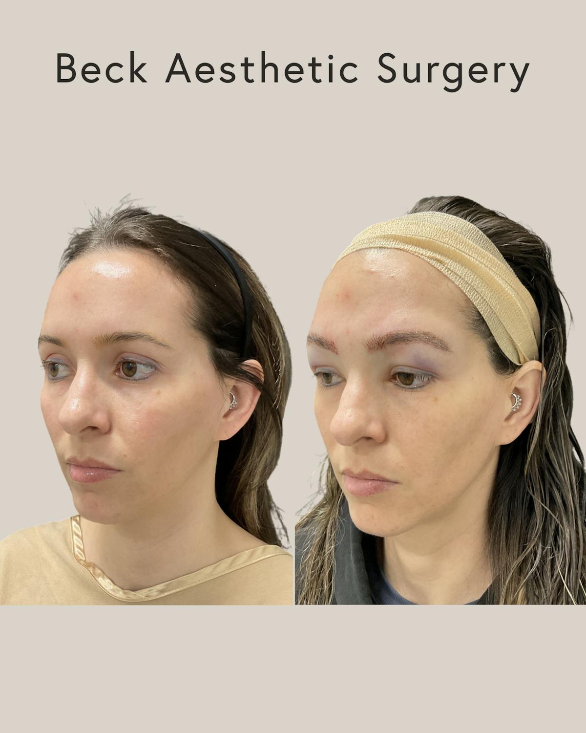 Hair Restoration Before & After Gallery - Patient 210456 - Image 1