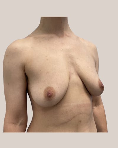 Top Surgery Before & After Gallery - Patient 687399 - Image 1