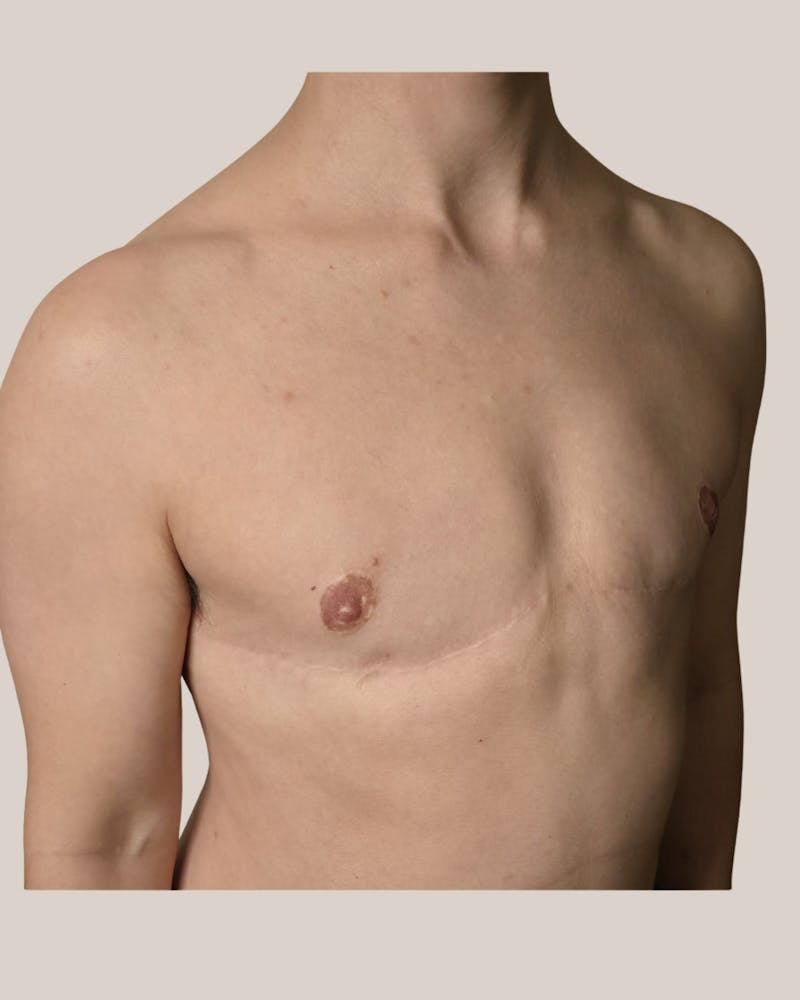 Top Surgery Before & After Gallery - Patient 687399 - Image 2
