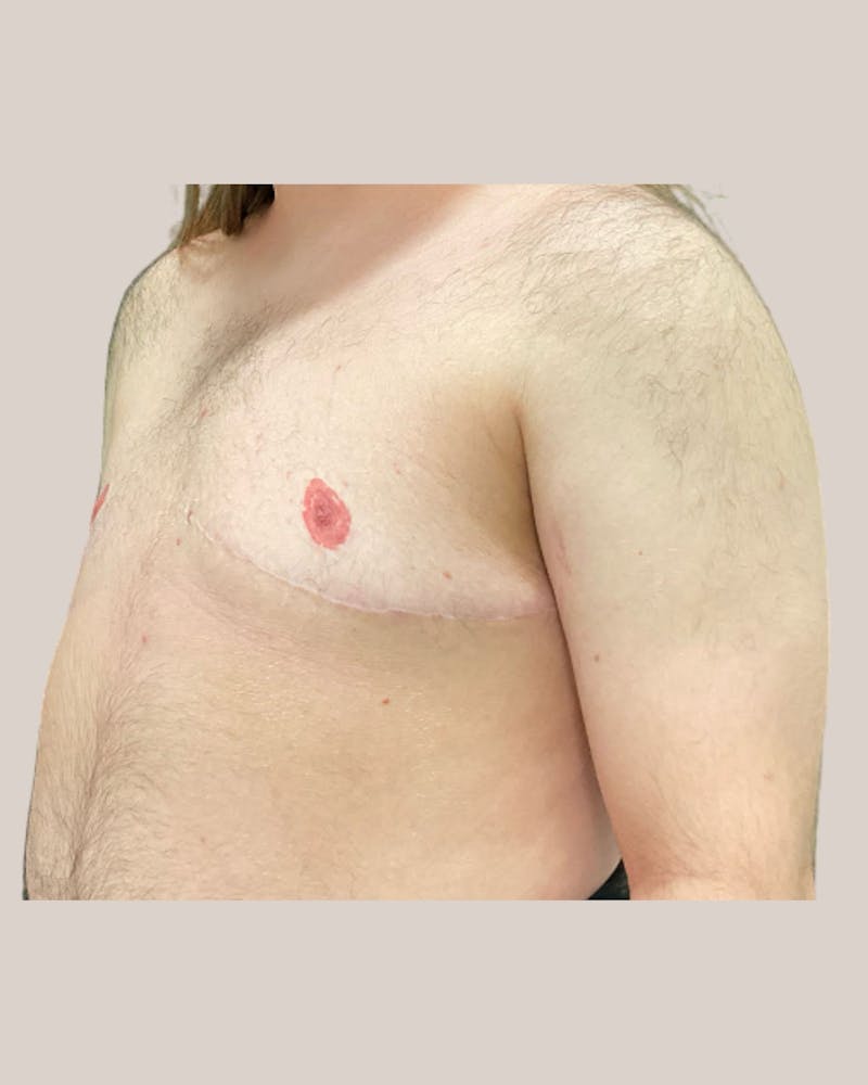 Top Surgery Before & After Gallery - Patient 123454 - Image 4
