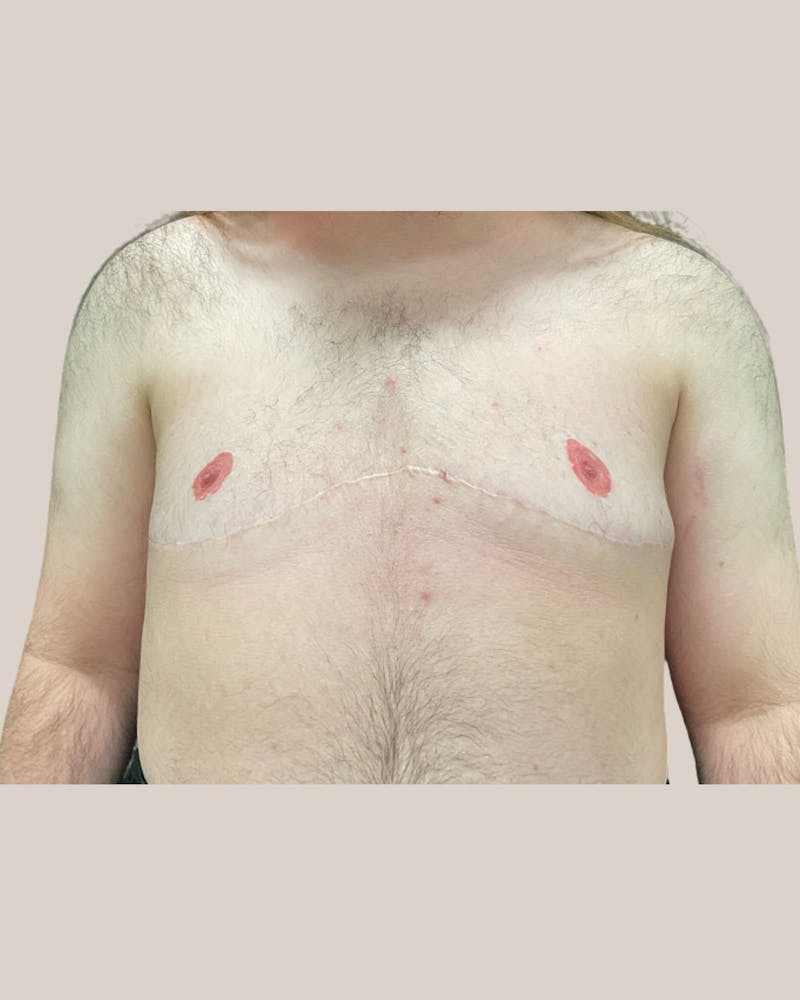 Top Surgery Before & After Gallery - Patient 123454 - Image 2