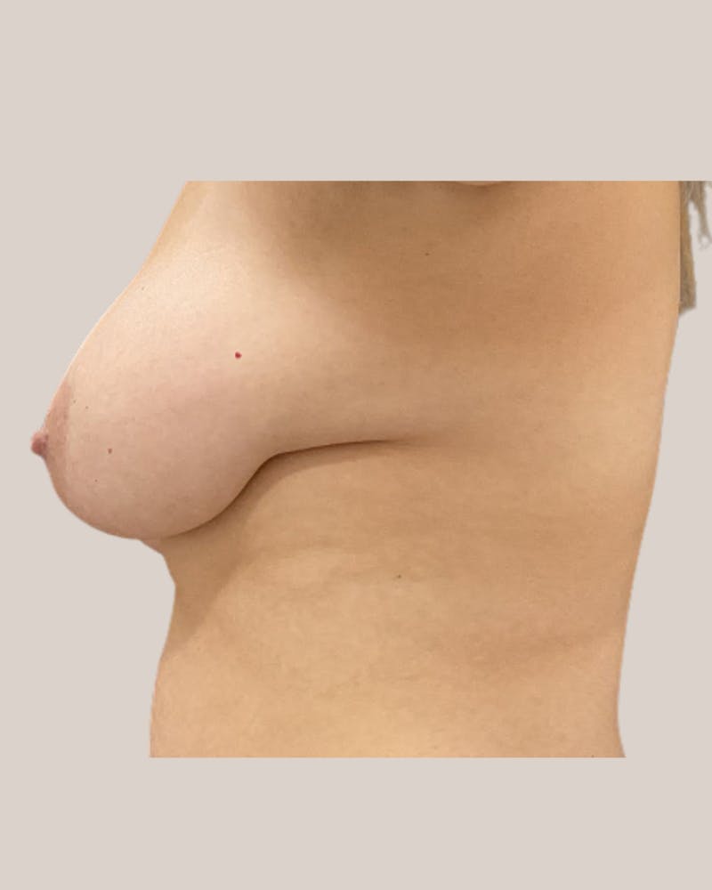 Breast Lift Before & After Gallery - Patient 238409 - Image 3