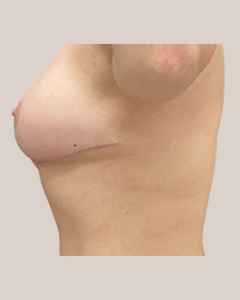 Breast Lift Before & After Gallery - Patient 238409 - Image 4