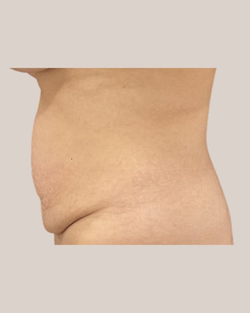 Tummy Tuck Before & After Gallery - Patient 406908 - Image 3