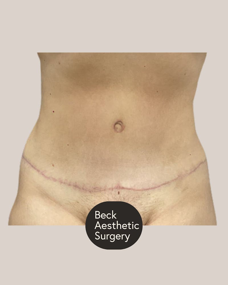 Tummy Tuck Before & After Gallery - Patient 406908 - Image 2