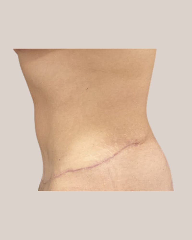 Tummy Tuck Before & After Gallery - Patient 406908 - Image 4
