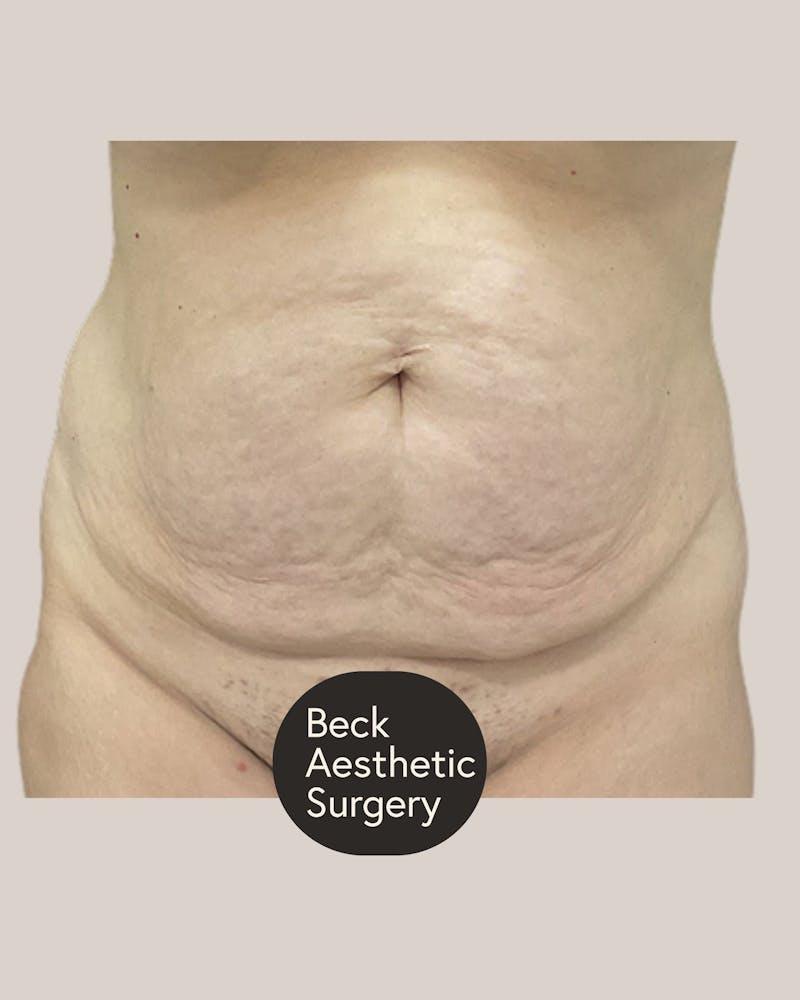 Tummy Tuck Before & After Gallery - Patient 406908 - Image 1