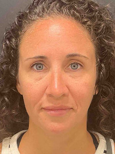 Injectables Before & After Gallery - Patient 682550 - Image 2