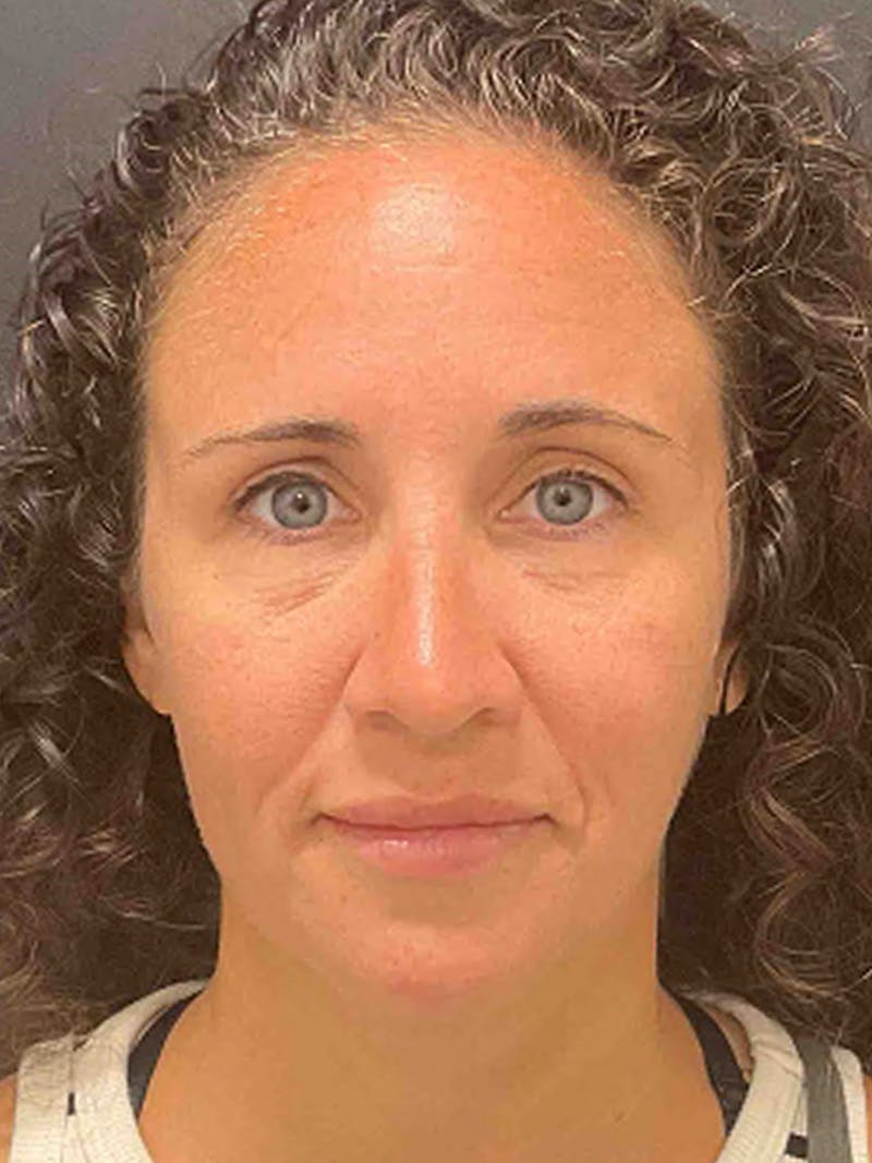 Injectables Before & After Gallery - Patient 682550 - Image 2