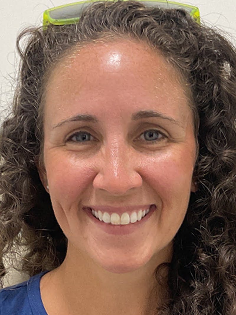 Injectables Before & After Gallery - Patient 682550 - Image 3