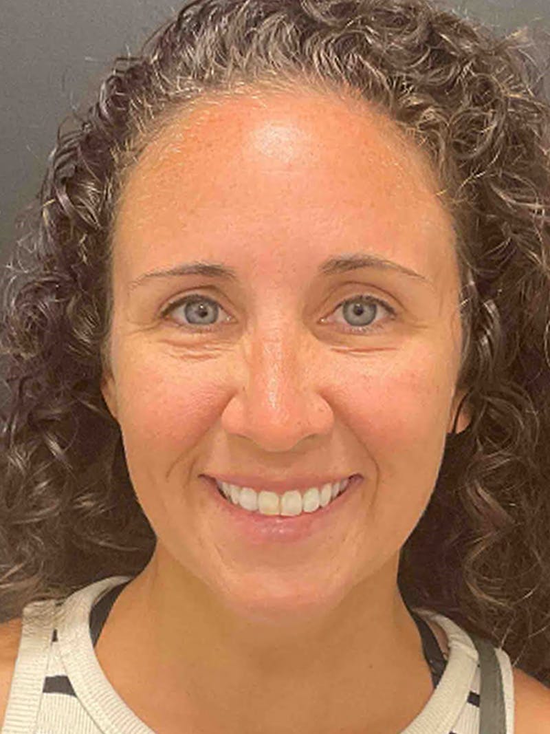 Injectables Before & After Gallery - Patient 682550 - Image 4
