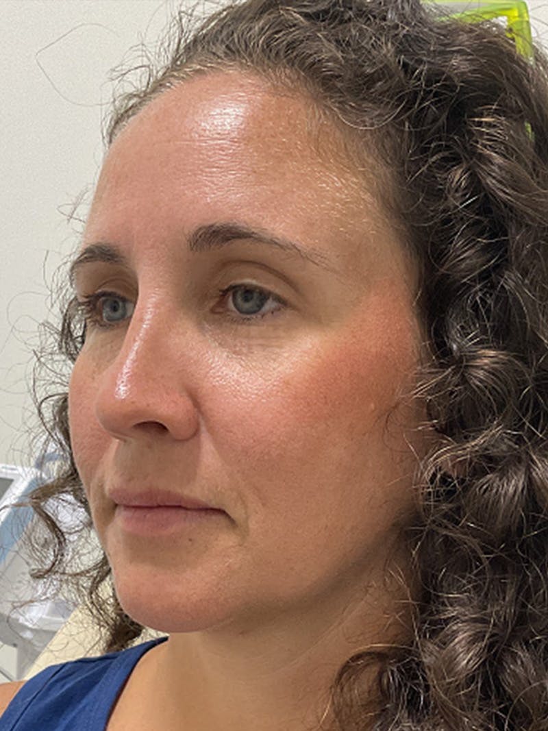 Injectables Before & After Gallery - Patient 682550 - Image 5