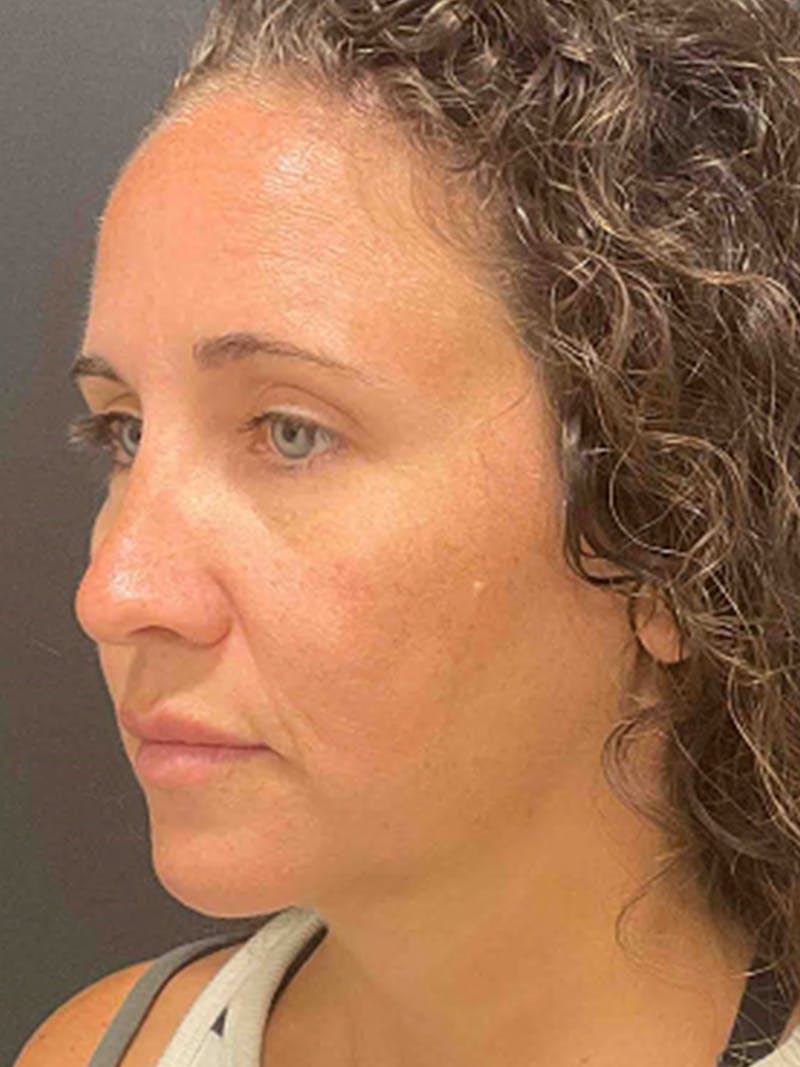 Injectables Before & After Gallery - Patient 682550 - Image 6