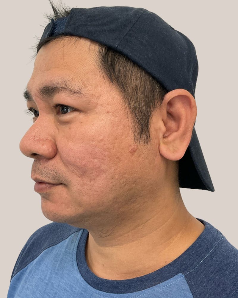 CO2 Laser Before & After Gallery - Patient 127597 - Image 6