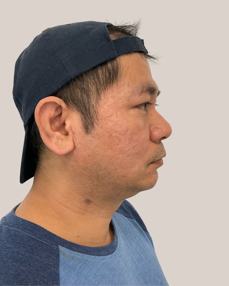 CO2 Laser Before & After Gallery - Patient 127597 - Image 4