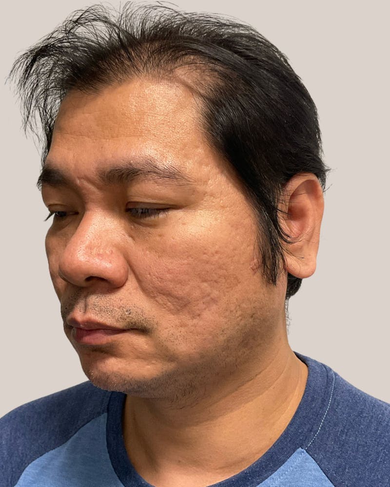 CO2 Laser Before & After Gallery - Patient 127597 - Image 5