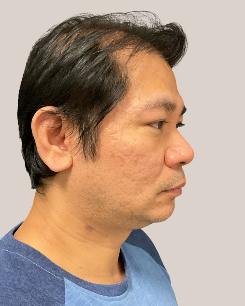 CO2 Laser Before & After Gallery - Patient 127597 - Image 3