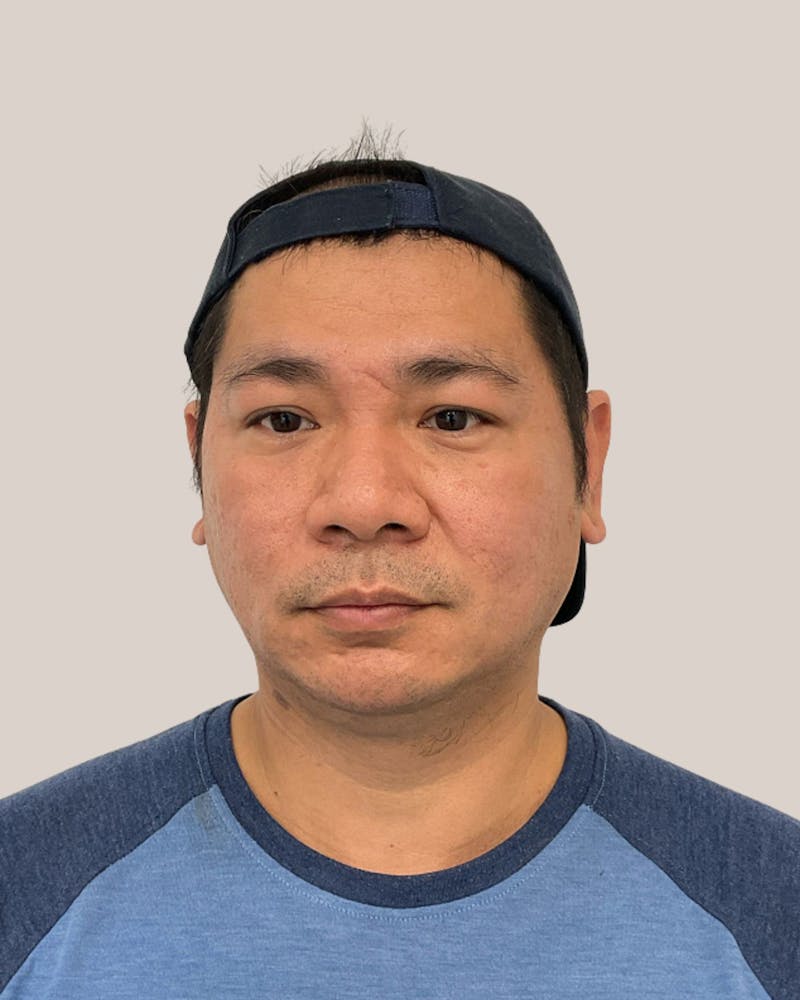 CO2 Laser Before & After Gallery - Patient 127597 - Image 2