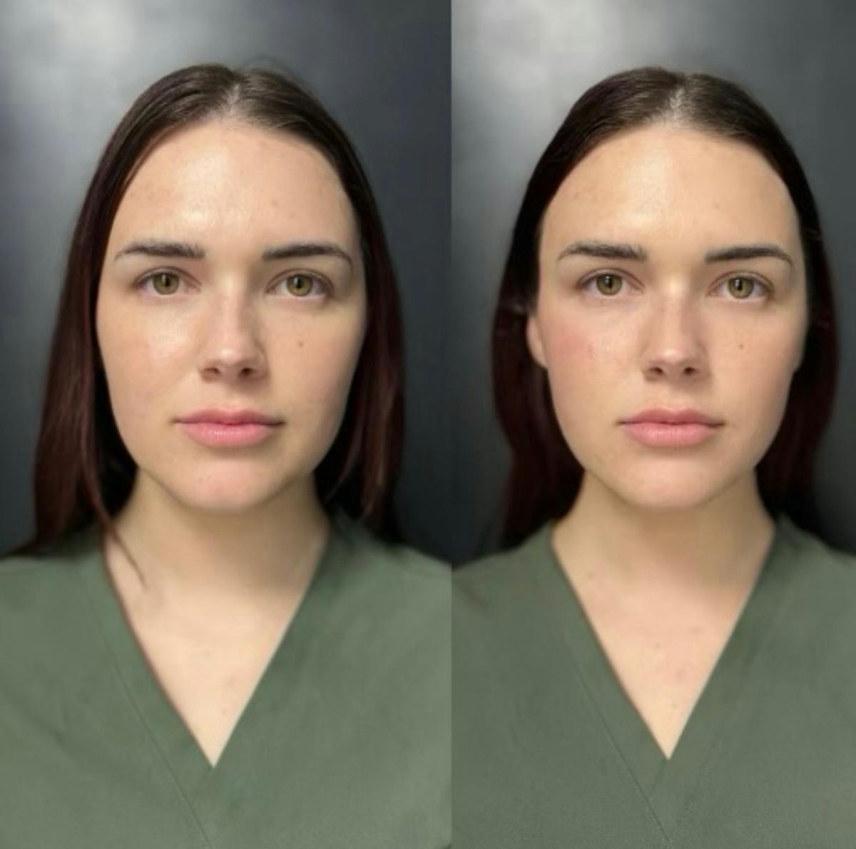Injectables Before & After Gallery - Patient 238595 - Image 1