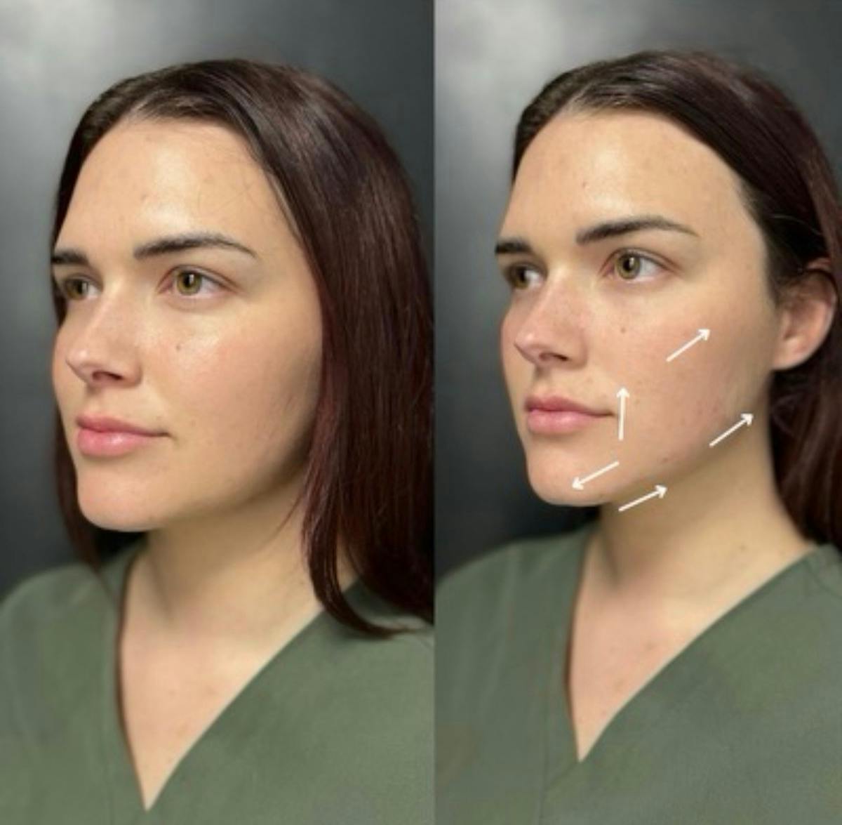 Injectables Before & After Gallery - Patient 238595 - Image 3