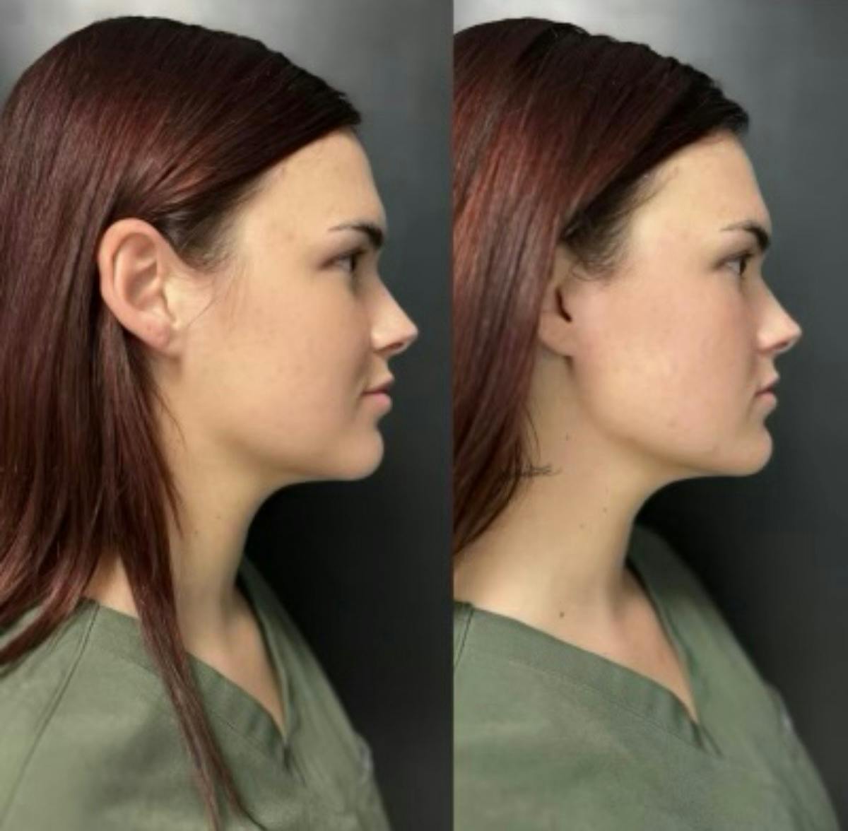Injectables Before & After Gallery - Patient 238595 - Image 2