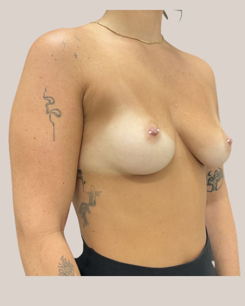 Breast Augmentation Before & After Gallery - Patient 371838 - Image 3