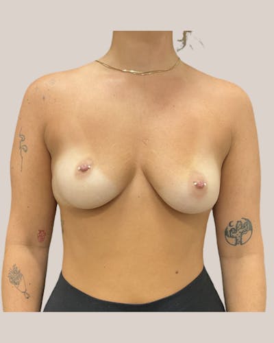 Breast Augmentation Before & After Gallery - Patient 371838 - Image 1