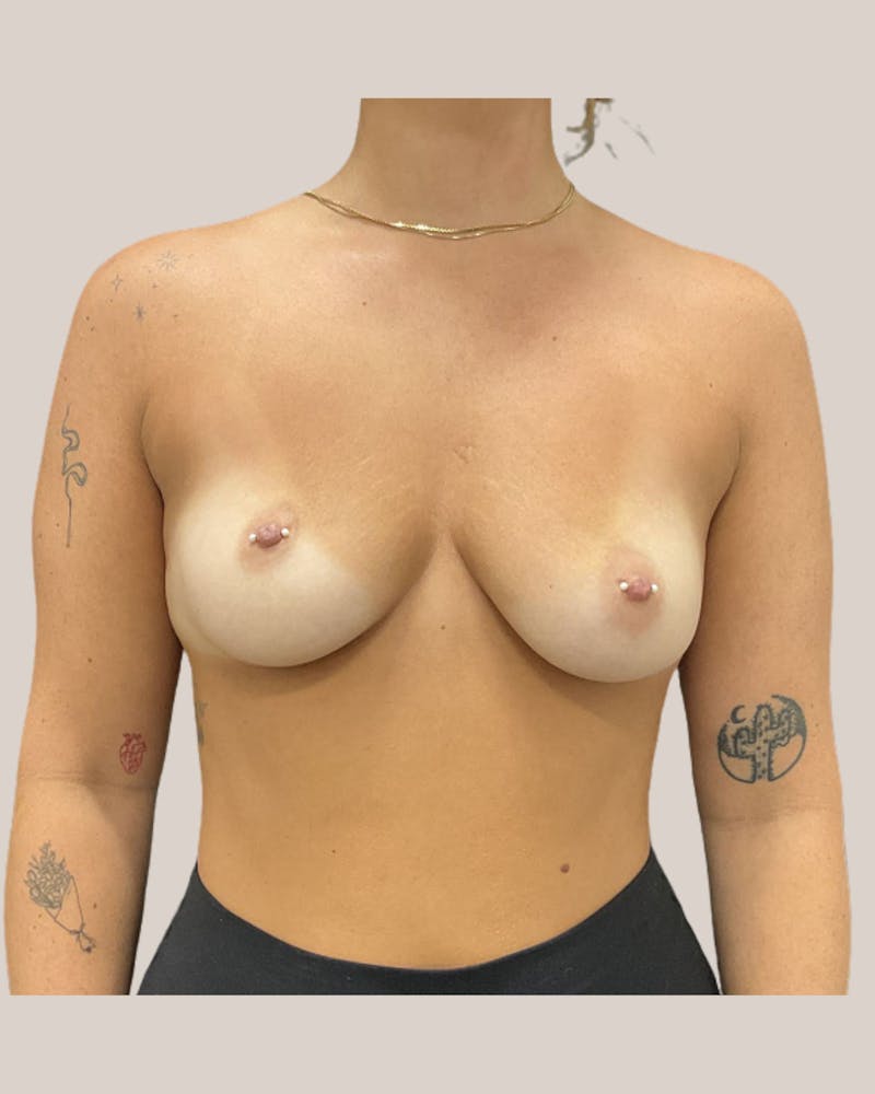 Breast Augmentation Before & After Gallery - Patient 371838 - Image 1