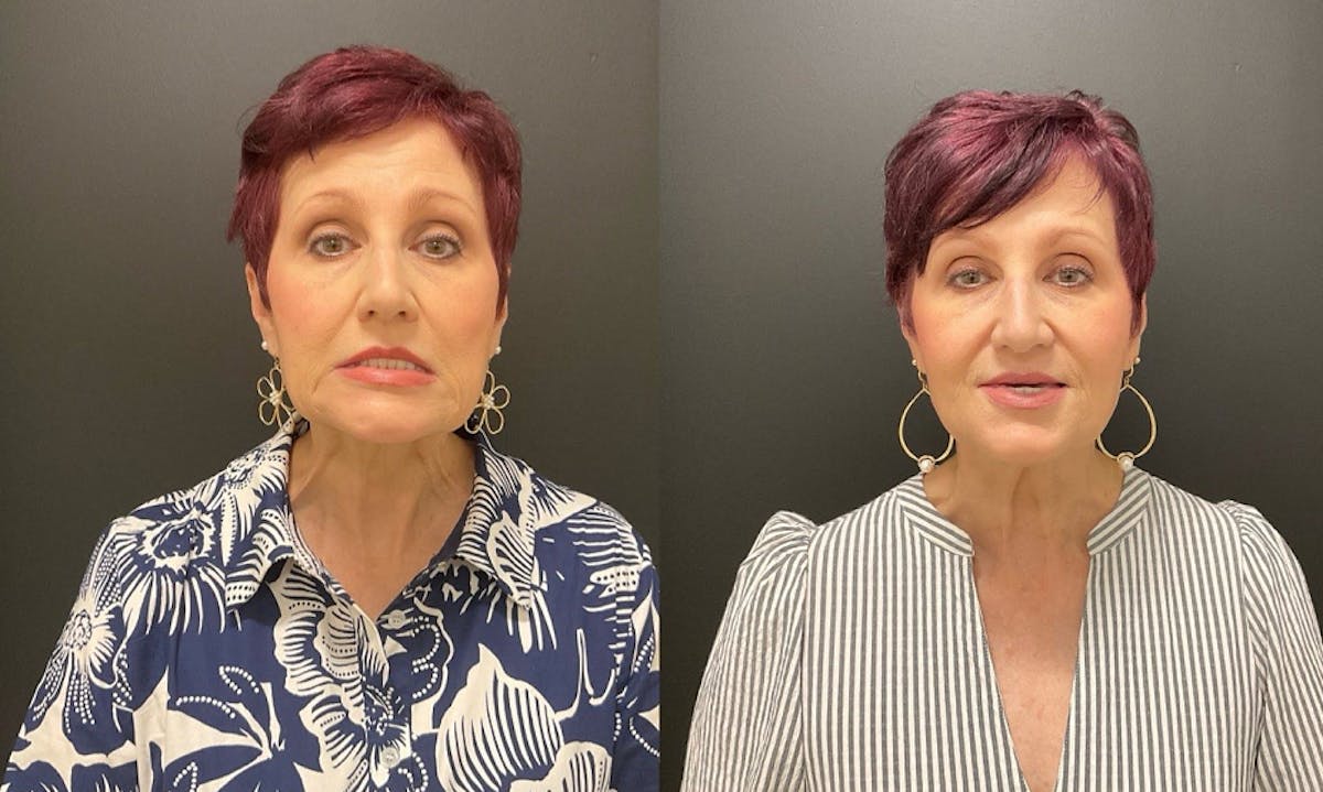 Injectables Before & After Gallery - Patient 287818 - Image 2