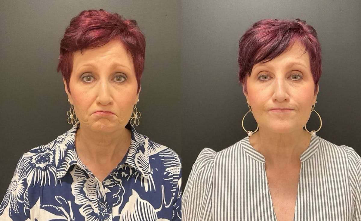 Injectables Before & After Gallery - Patient 287818 - Image 1
