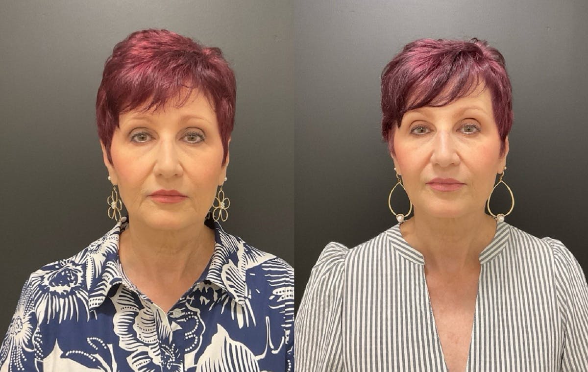Injectables Before & After Gallery - Patient 287818 - Image 4