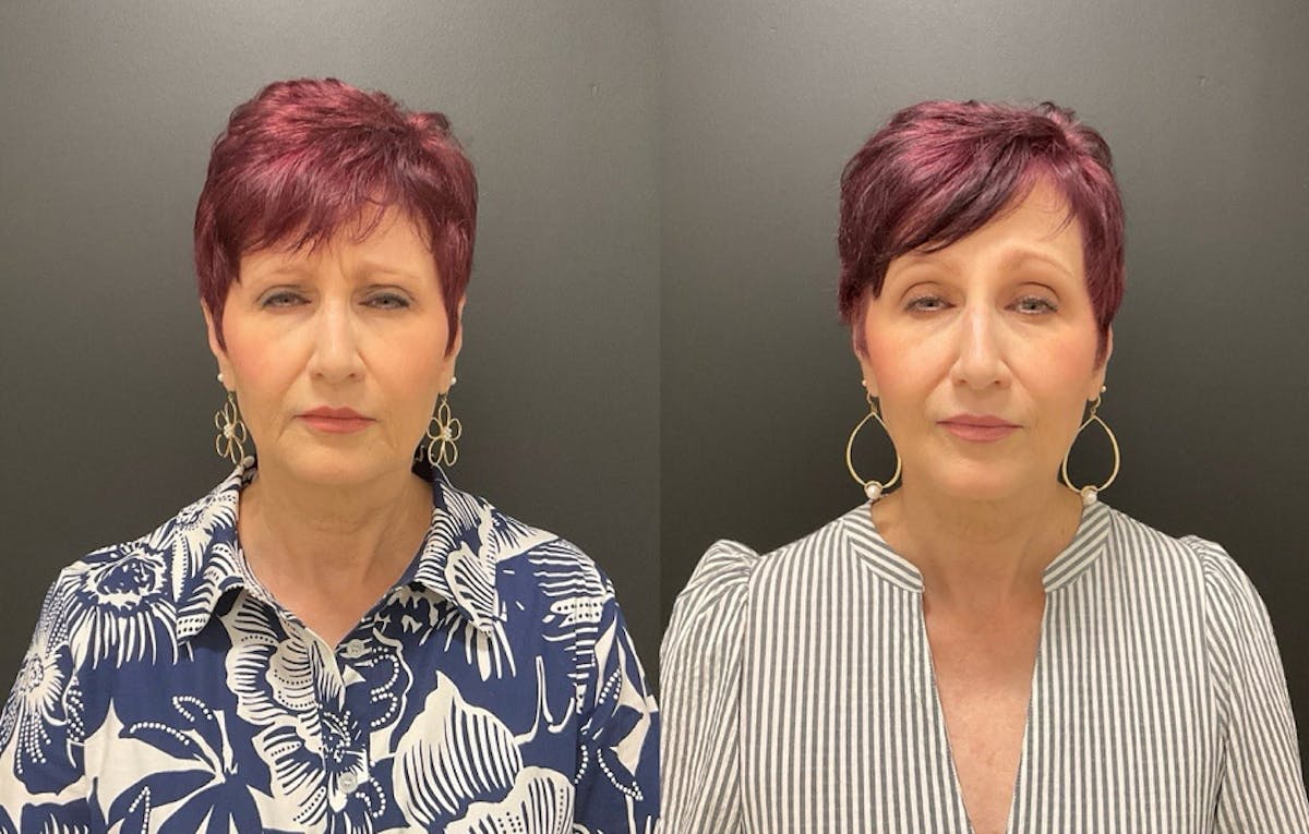 Injectables Before & After Gallery - Patient 287818 - Image 3