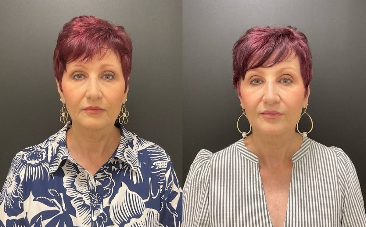 Injectables Before & After Gallery - Patient 287818 - Image 7