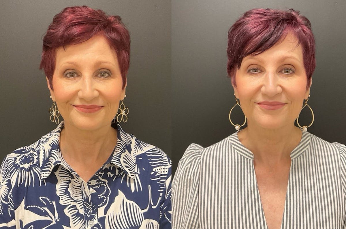 Injectables Before & After Gallery - Patient 287818 - Image 6