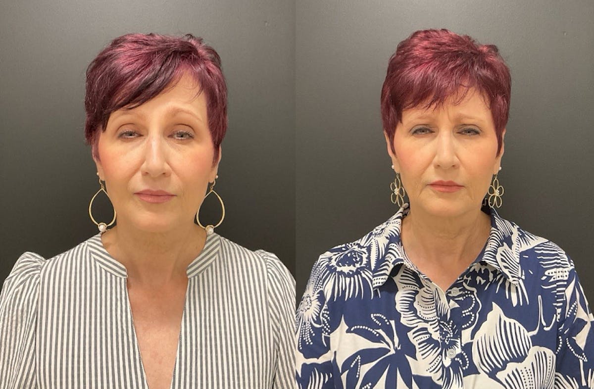 Injectables Before & After Gallery - Patient 287818 - Image 5