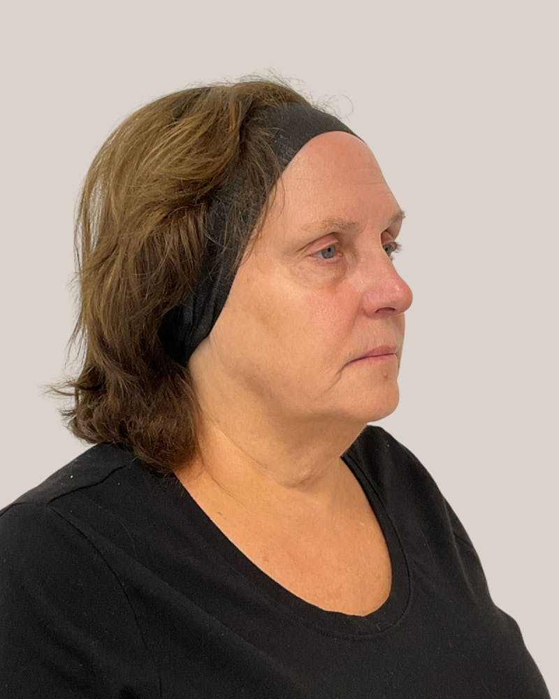 Microneedling Before & After Gallery - Patient 297620 - Image 4