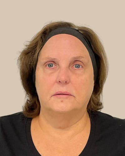 BBL Forever Young Before & After Gallery - Patient 160318 - Image 2